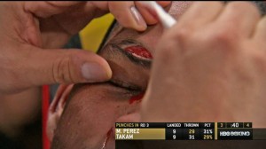 Mike Perez Fights Through Horrible Head Butt Cut to Draw With Carlos Takam 23 Mike Perez cut