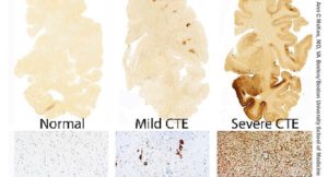 Brain Health in MMA and Boxing 2 1