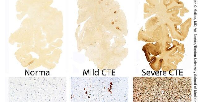 Brain Health in MMA and Boxing 2 1